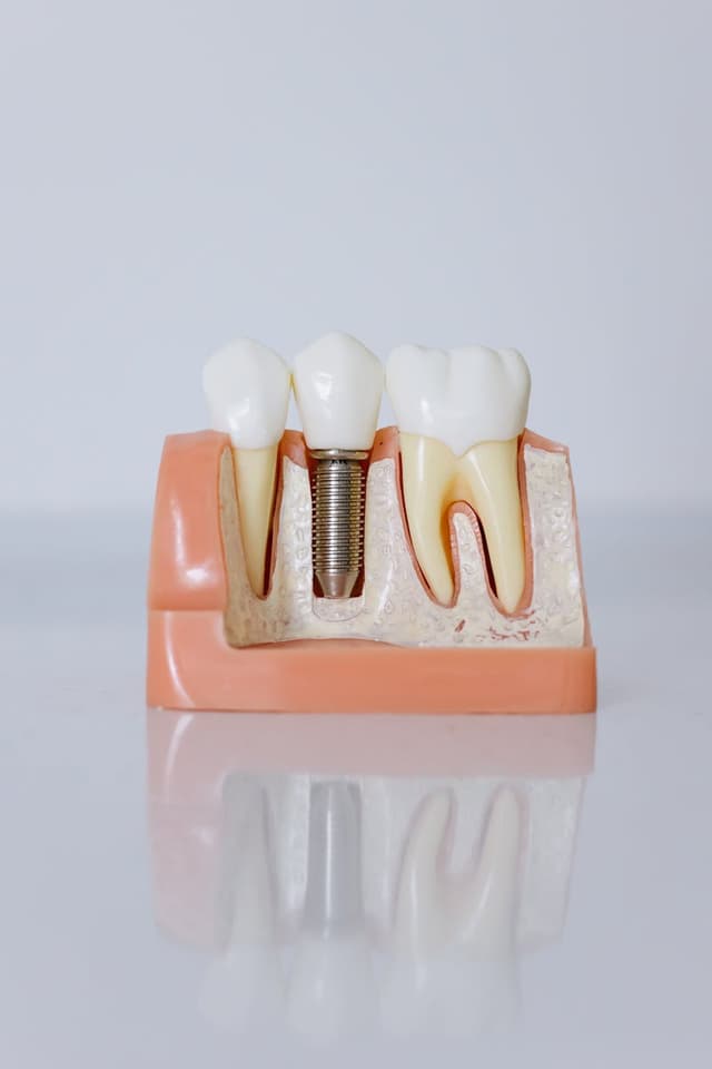 Dental implant model showing implant-retained denture
